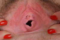 ATK hairy  in young and hairy