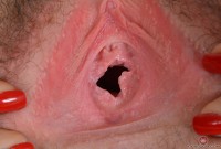 ATK hairy  in young and hairy