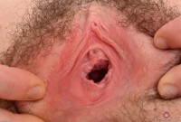 ATK hairy  in young and hairy