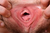 ATK hairy  in young and hairy
