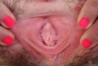 ATK hairy  in young and hairy