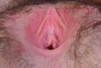 ATK hairy  in young and hairy