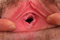 ATK hairy  in young and hairy