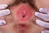 ATK hairy  in young and hairy