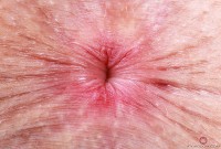 ATK hairy  in young and hairy