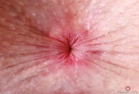 ATK hairy  in young and hairy