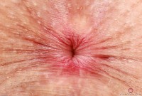 ATK hairy  in young and hairy