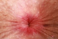 ATK hairy  in young and hairy