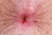 ATK hairy  in young and hairy