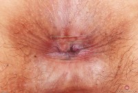 ATK hairy  in mature and hairy