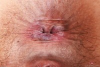 ATK hairy  in mature and hairy