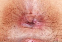 ATK hairy  in mature and hairy