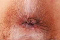 ATK hairy  in mature and hairy