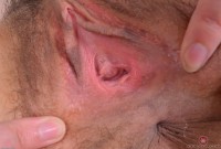 ATK hairy  in young and hairy
