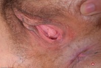 ATK hairy  in young and hairy