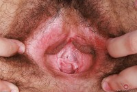 ATK hairy  in young and hairy