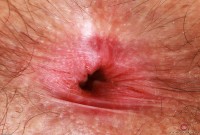 ATK hairy  in young and hairy