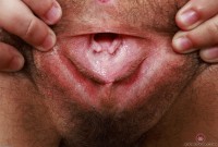 ATK hairy  in young and hairy