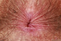 ATK hairy  in young and hairy