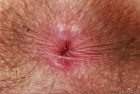 ATK hairy  in young and hairy