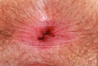 ATK hairy  in young and hairy