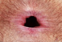 ATK hairy  in young and hairy