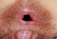 ATK hairy  in young and hairy