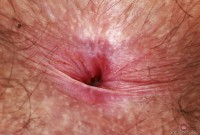 ATK hairy  in young and hairy