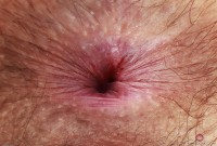 ATK hairy  in young and hairy