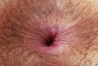 ATK hairy  in young and hairy