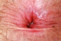 ATK hairy  in young and hairy