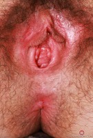 ATK hairy  in young and hairy