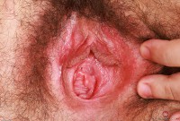ATK hairy  in young and hairy