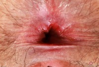 ATK hairy  in young and hairy