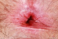 ATK hairy  in young and hairy