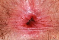 ATK hairy  in young and hairy