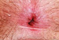 ATK hairy  in young and hairy