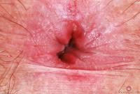 ATK hairy  in young and hairy