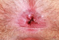 ATK hairy  in young and hairy
