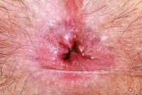 ATK hairy  in young and hairy