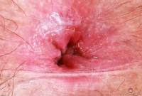 ATK hairy  in young and hairy