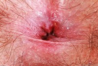 ATK hairy  in young and hairy