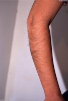 ATK hairy  in young and hairy