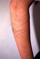 ATK hairy  in young and hairy