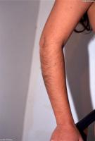 ATK hairy  in young and hairy