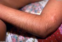 ATK hairy  in young and hairy