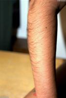 ATK hairy  in young and hairy