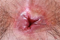 ATK hairy  in exotic and hairy