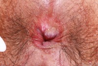 ATK hairy  in exotic and hairy