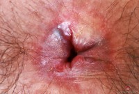 ATK hairy Hazel Heart Set